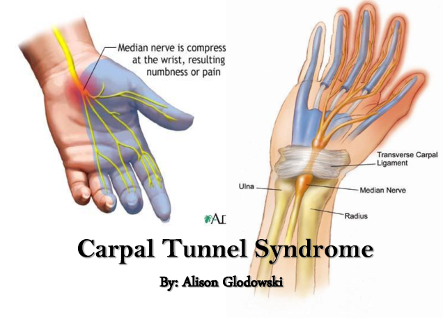 carpel-tunnel.png