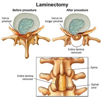laminectomy-surgery1.jpg